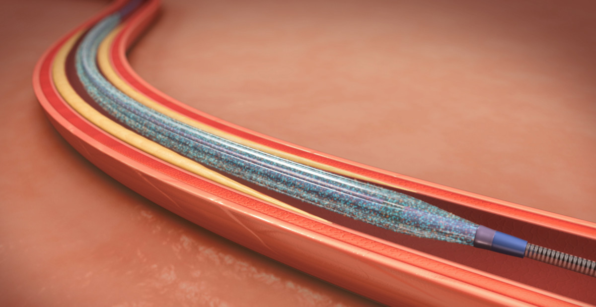 Development of Balloon Materials - Catheter Coatings - Cheersonic